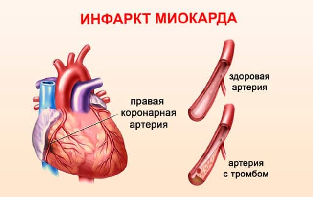 Как лечить крупноочаговый инфаркт миокарда thumbnail