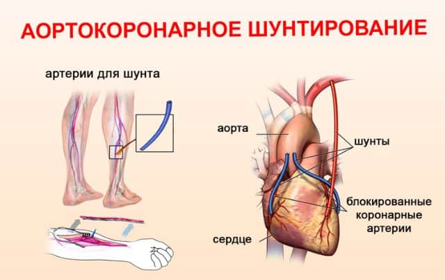 Какие бывают операции на сердце при инфаркте thumbnail