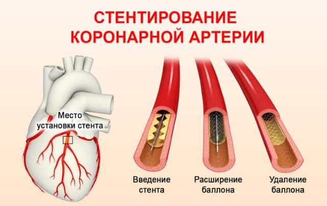 Какие бывают операции на сердце при инфаркте миокарда thumbnail