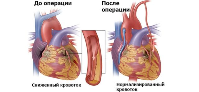 Шунтирование сердца по поводу инфаркта миокарда thumbnail