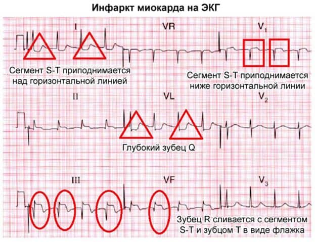 Экг признаки инфаркта миокарда трансмурального thumbnail