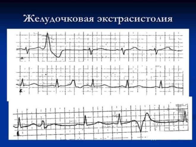 Экстрасистолия на фоне стресса форум