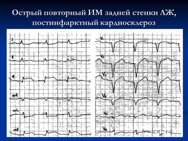 Постинфарктный кардиосклероз на экг фото с описанием